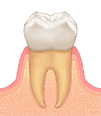 歯肉炎についての知識を知っておきましょう！